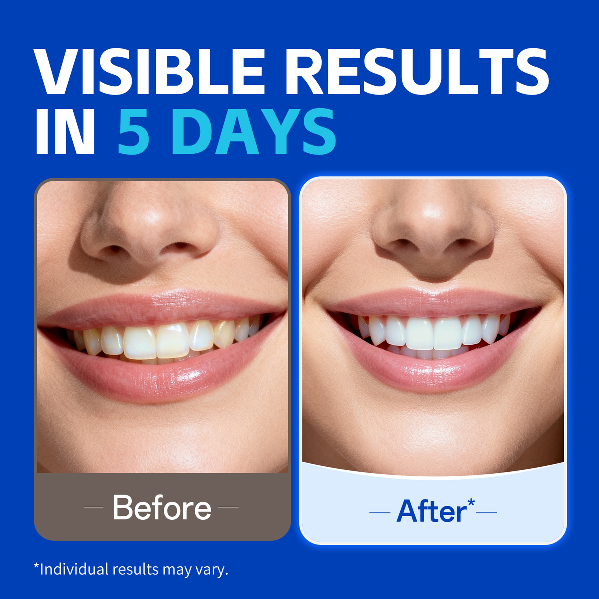 PERSMAX Teeth Whitening Strips – Professional Dentist Approved, Gum-Safe Formula, 28 Non-Slip Strips Kit, 14 Treatment, Pain-Free Express Whitening in 30 Min, Easy to Use for Bright Smile - PERSMAX